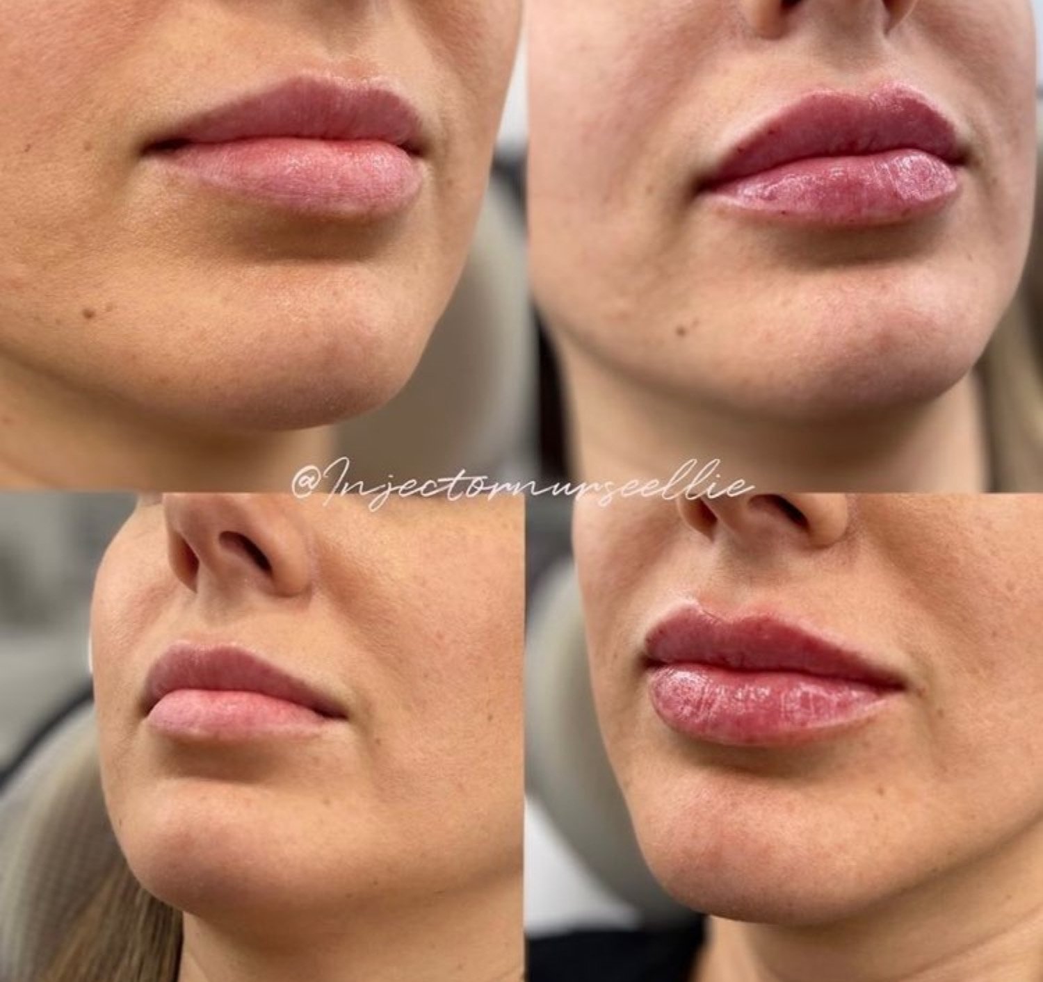 Ellie Lambert lip results before and after.jpg