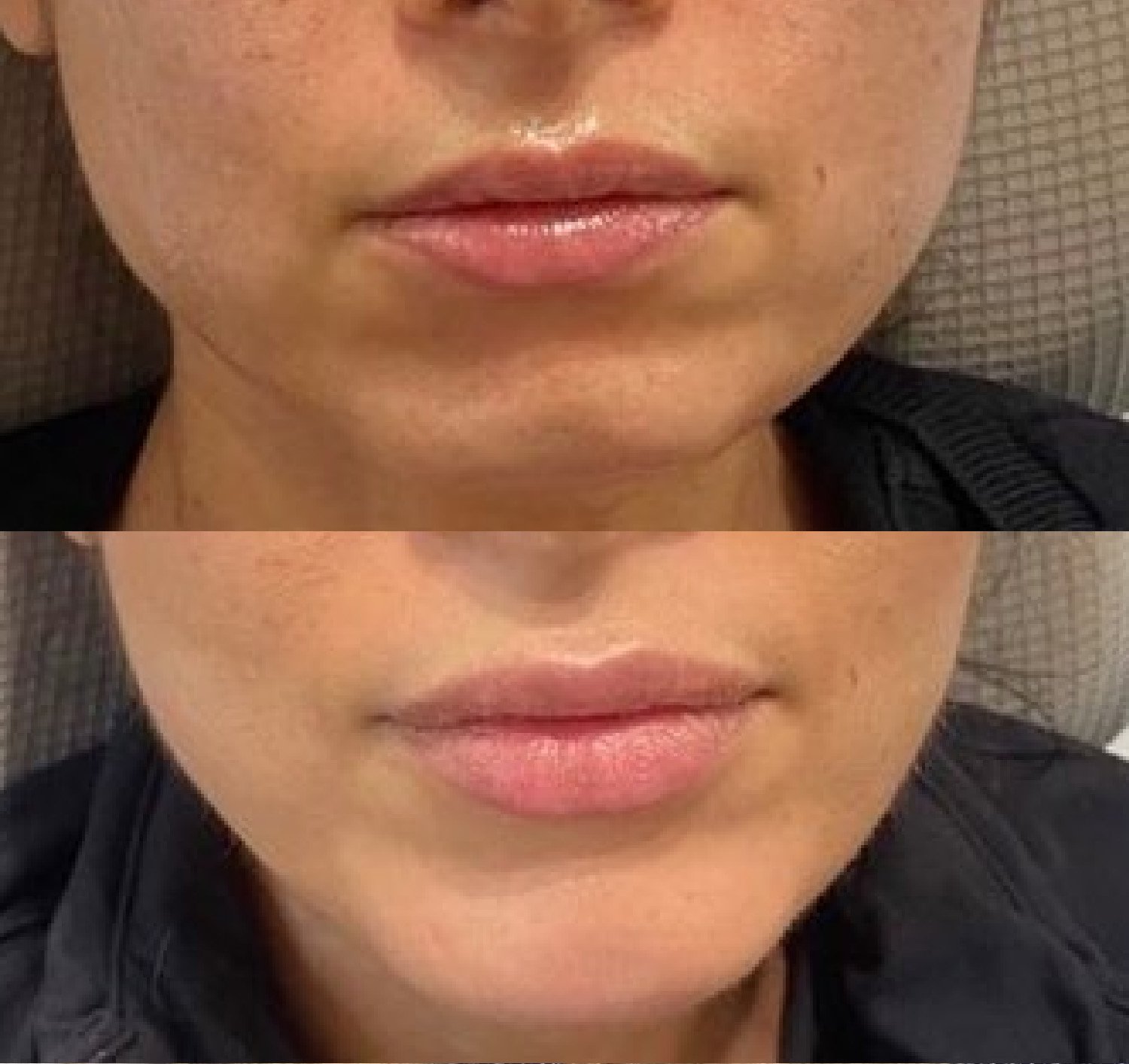 Ellie Lambert natural looking lip with filler botox before and after.jpg