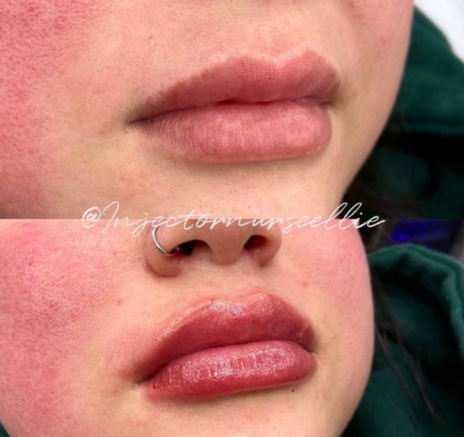 Ellie Lambert natural looking plump lips with botox before and after.jpg