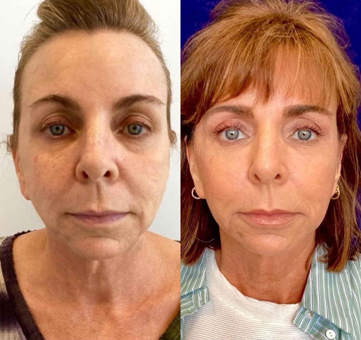 Lisa Azevedo botox for smiles lines before and after.jpg