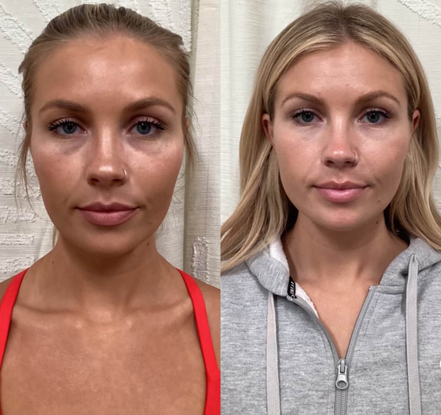 Maggie Cadavero before and after botox under eyes.jpg