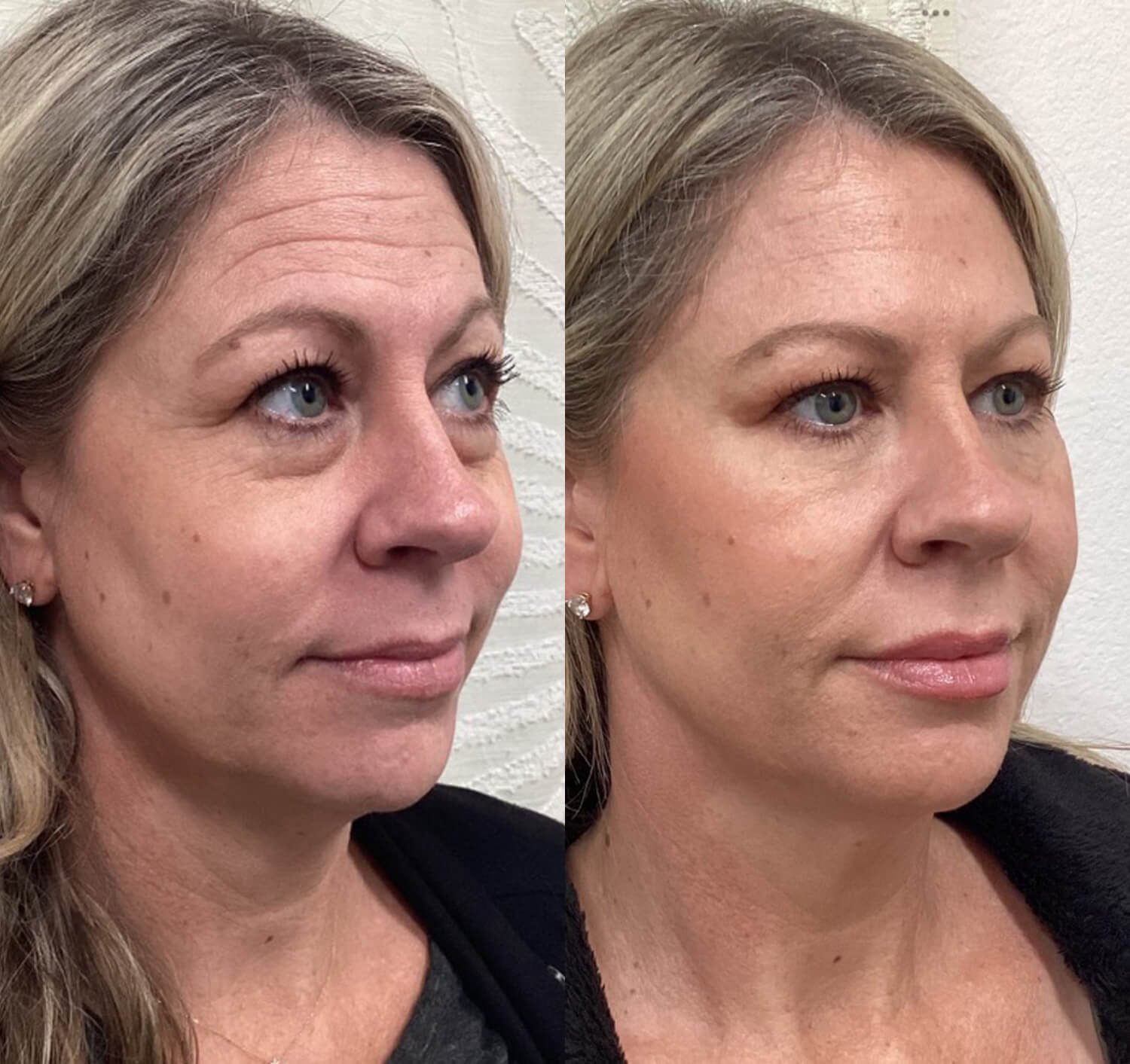 Maggie Cadavero under eye wrinkles botox before and after.jpg