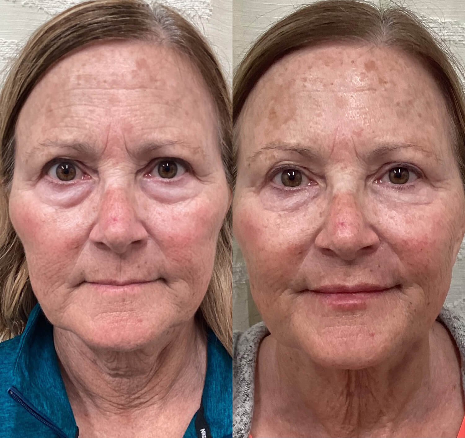 Maggie Cadavero botox for under eye wrinkles when smiling before and after.jpg