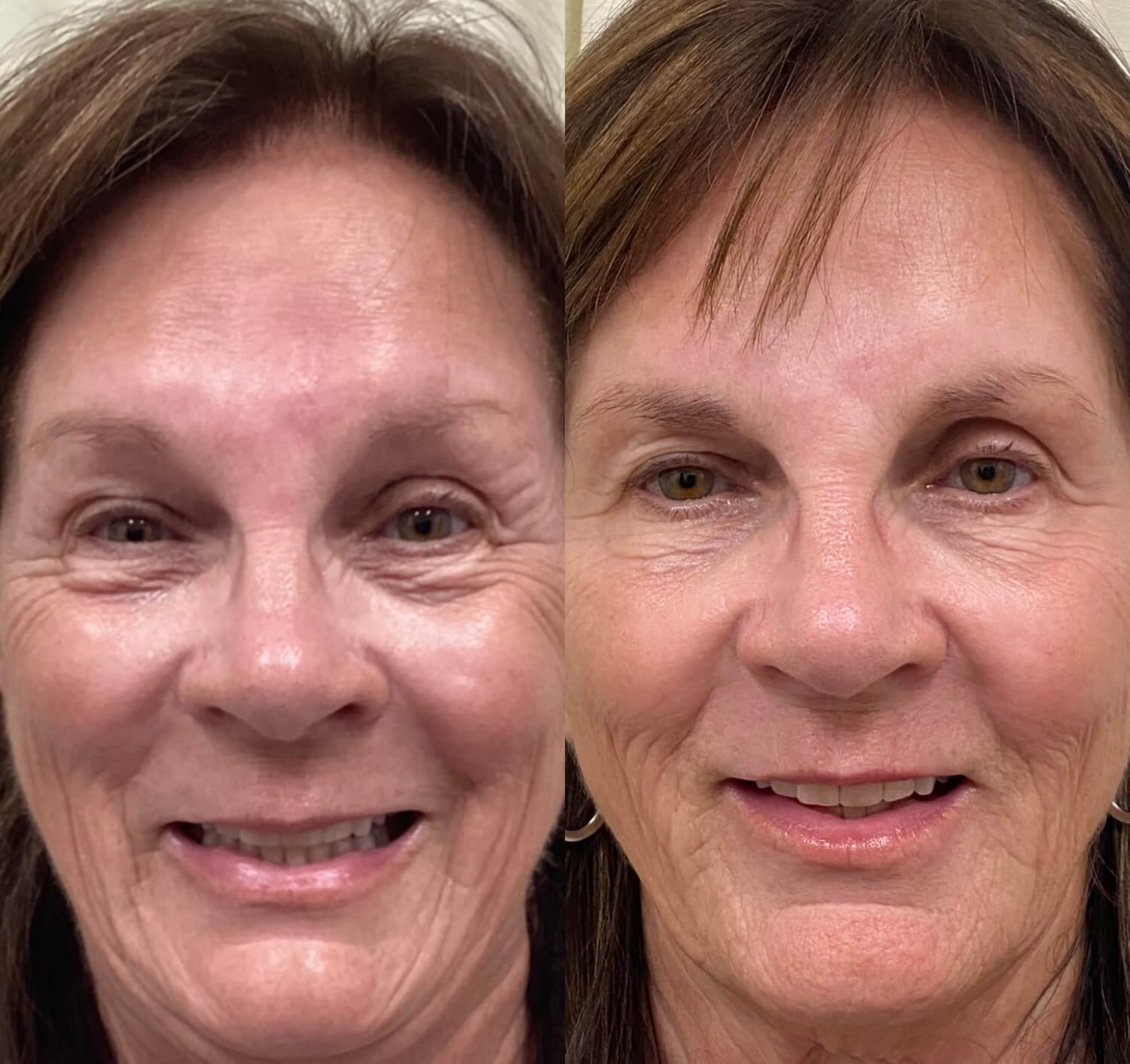 Maggie Cadavero botox for eye wrinkles before and after.jpg