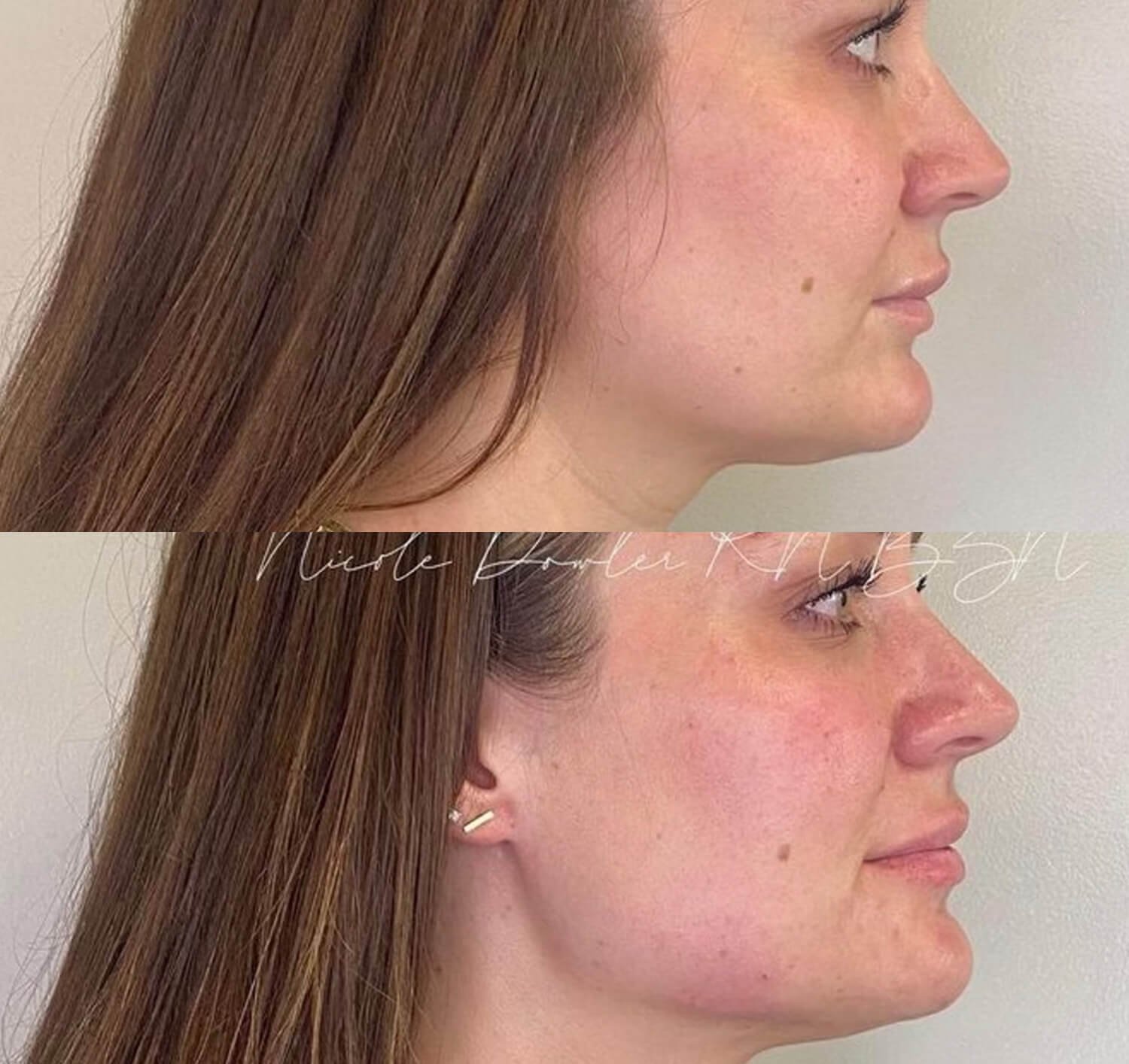 Nicole Dowler natural looking refined jawline botox before and after.jpg