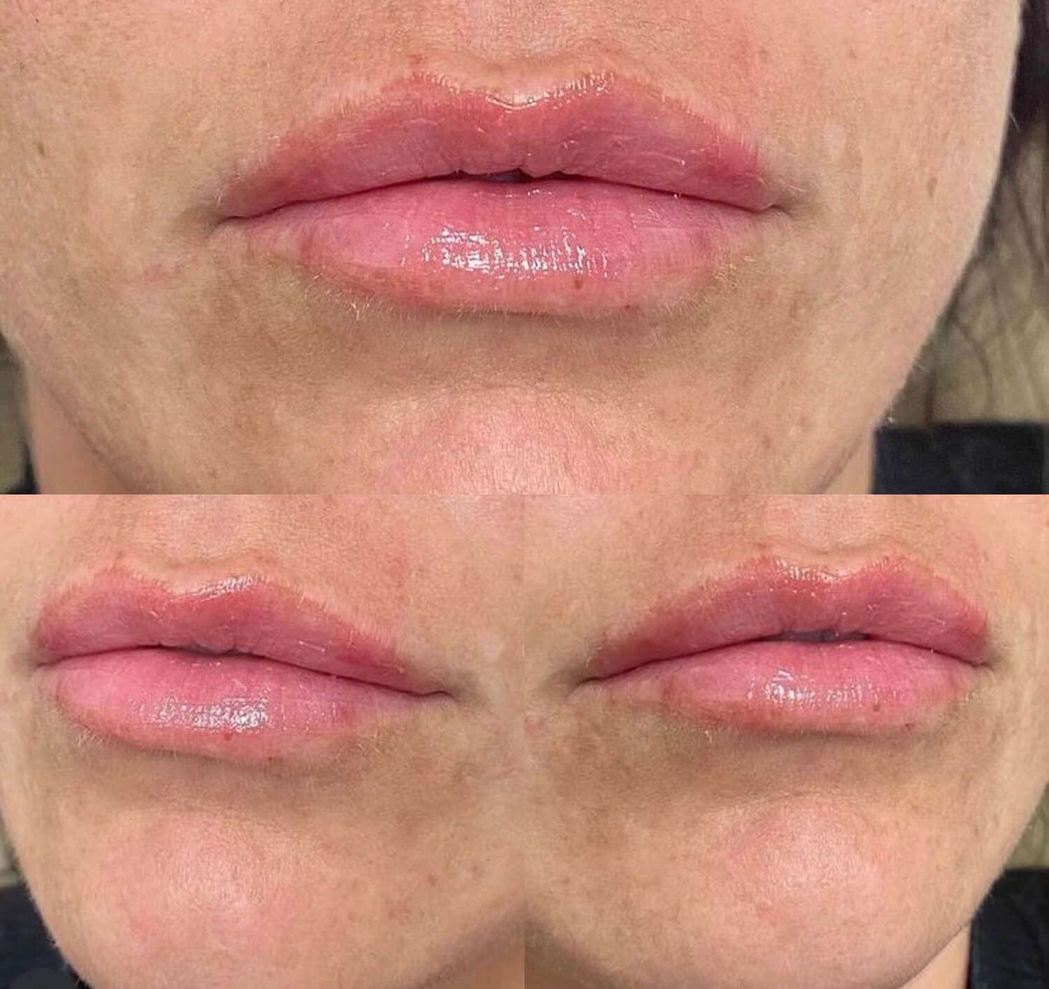 Nicole Dowler natural looking plump lip results.jpg