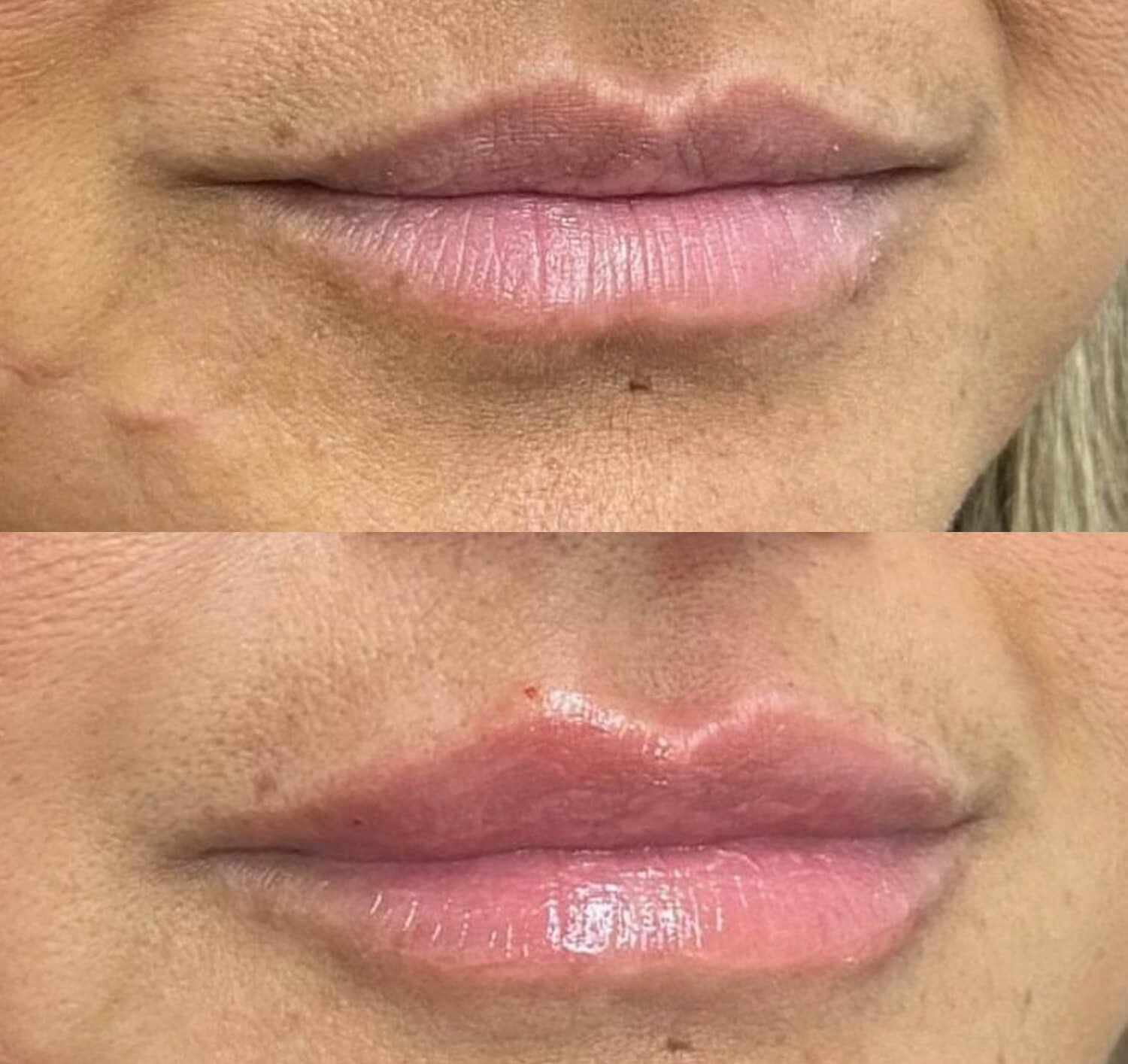 Nicole Dowler lip filler before and after.jpg