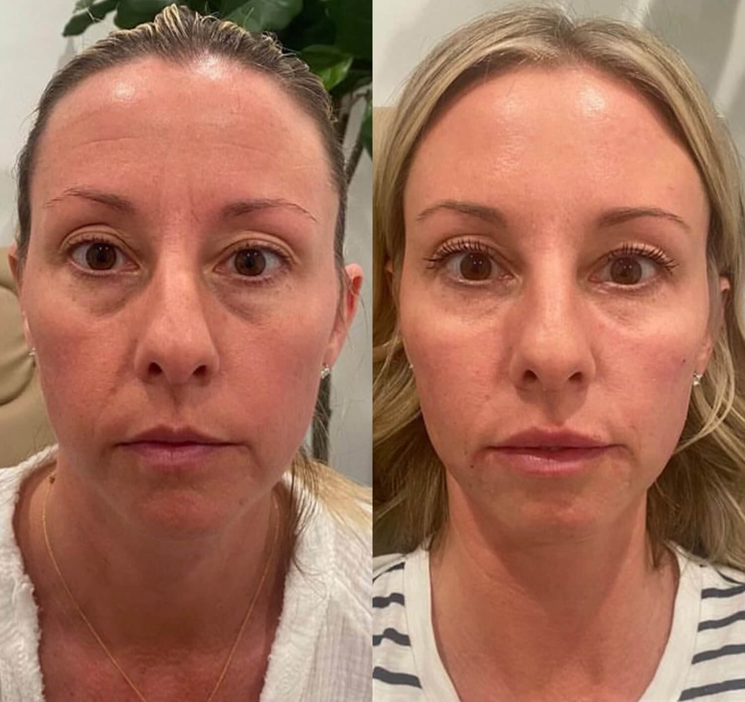 NIcole Dowler botox under eyes before and after.jpg