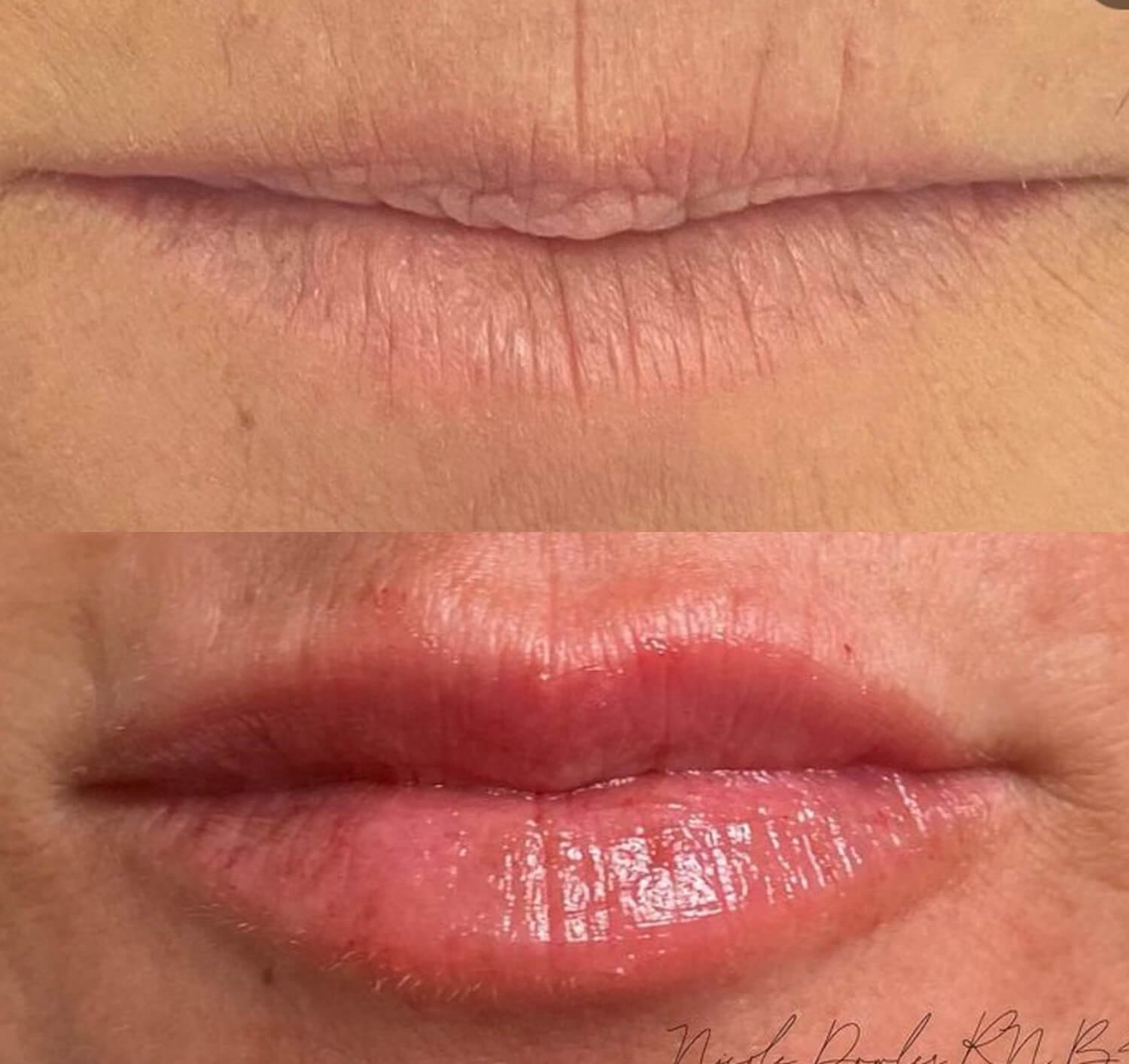 Nicole Dowler natural looking lip filler before and after.jpg
