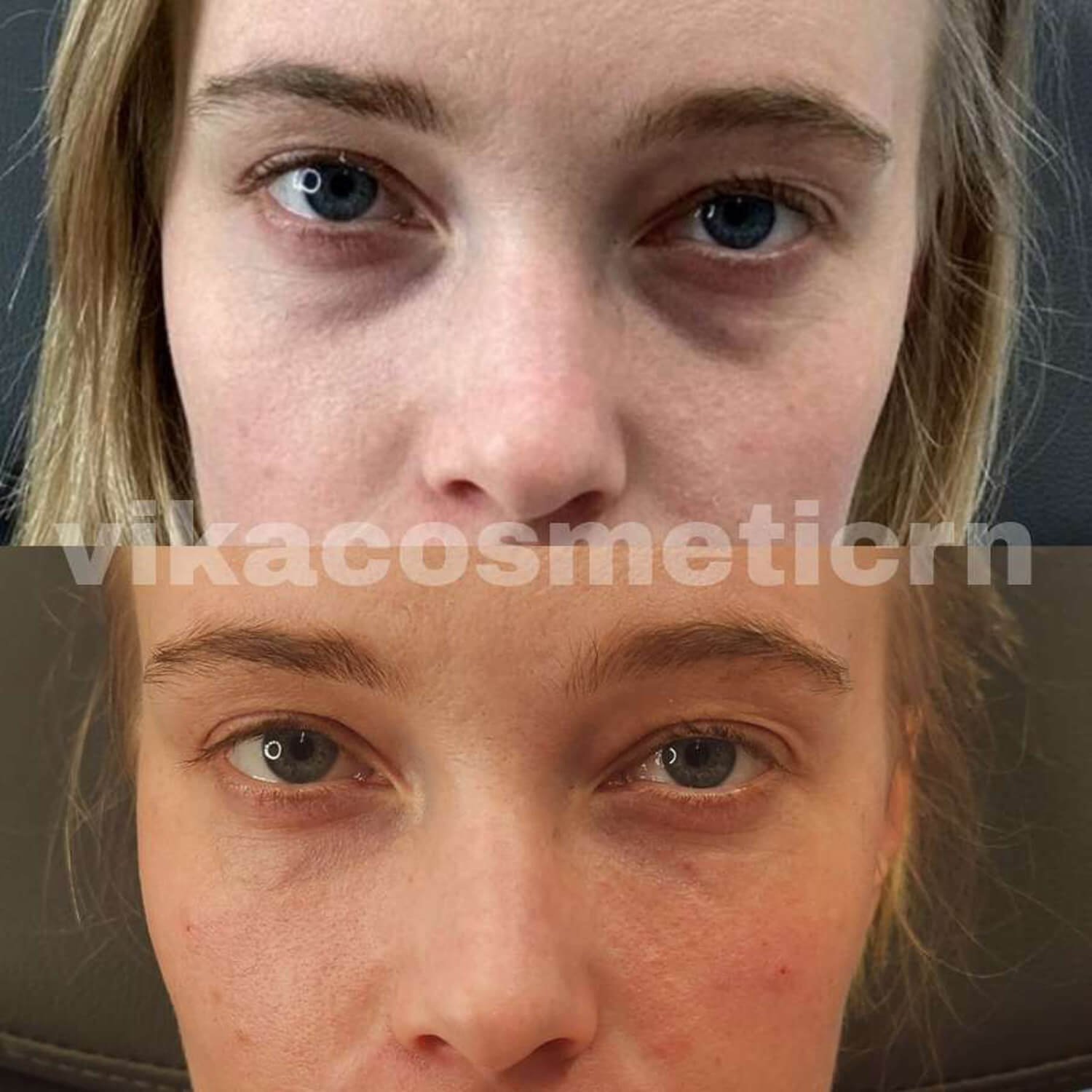 Vika Hawkins botox under eyes before and after.jpg