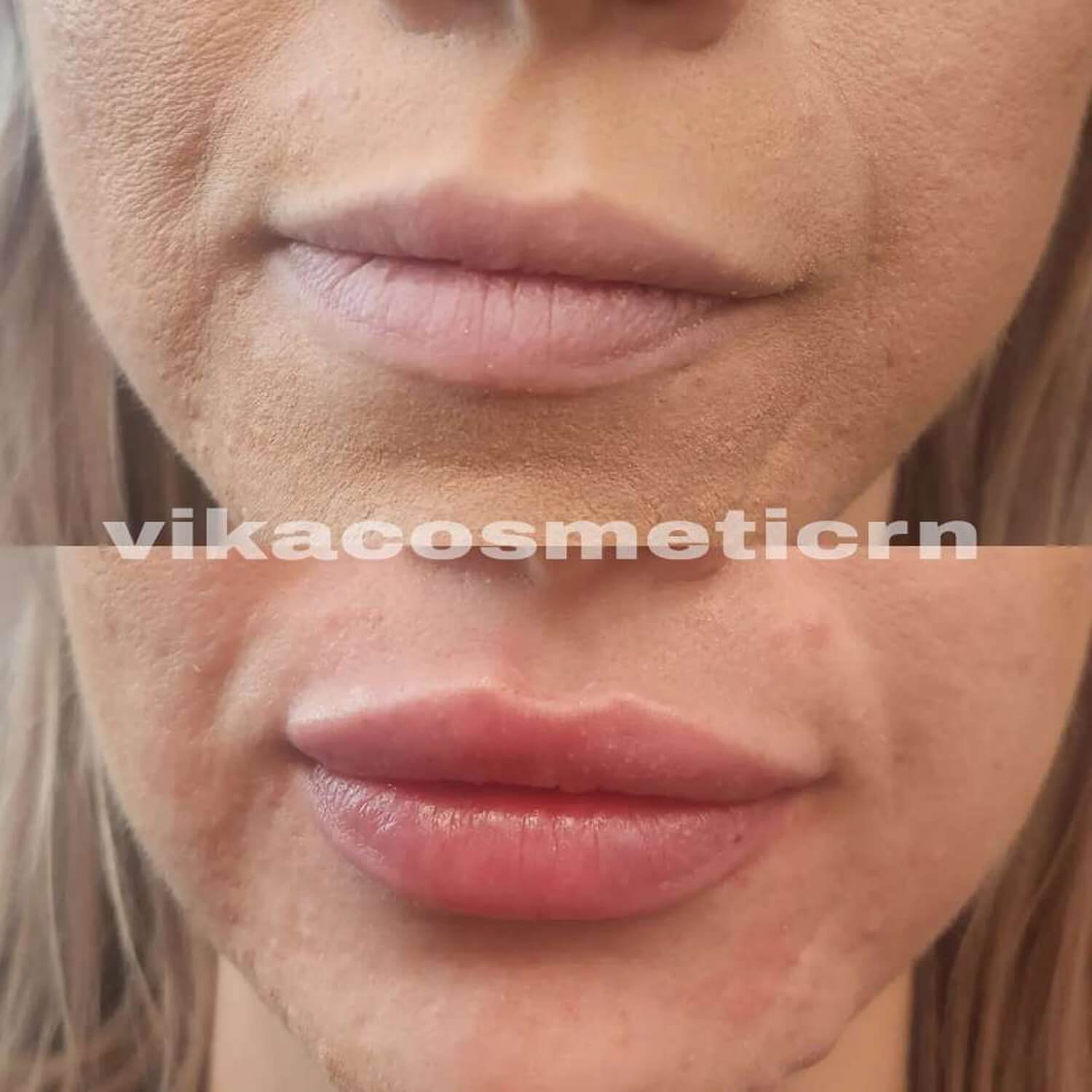 Vika Hawkins natural looking lip flip results.jpg