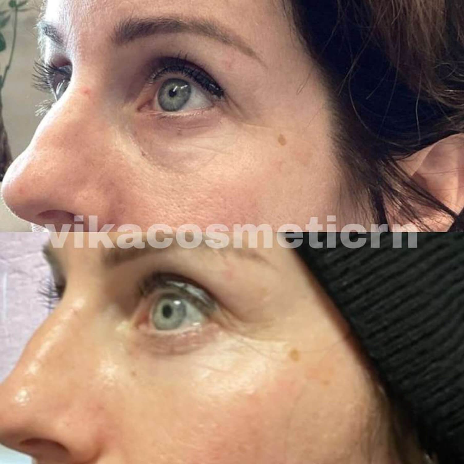 Vika Hawkins botox around eyes before and after.jpg
