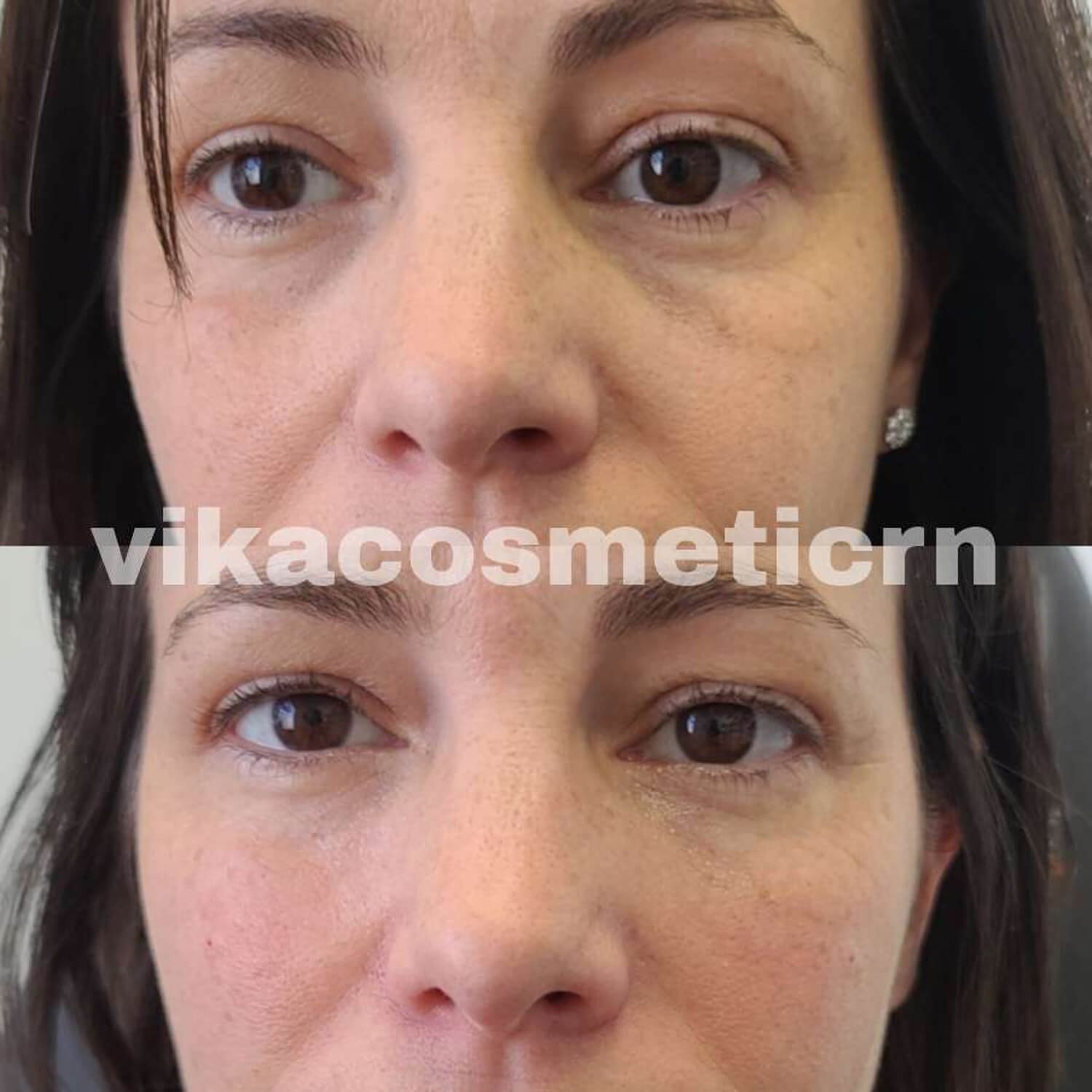 Vika Hawkins botox eyes before and after.jpg