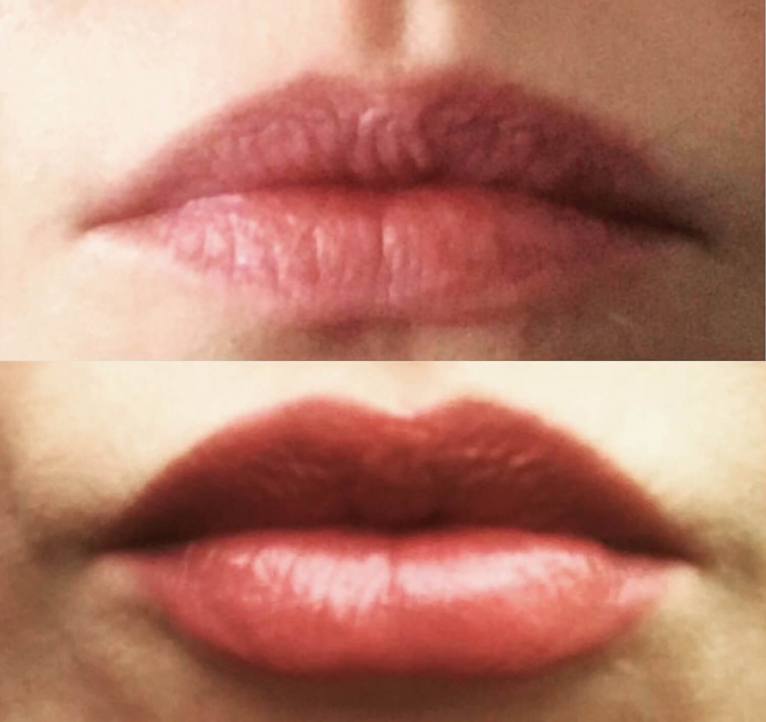 Lisa Azevedo before after botox lip filler.jpg