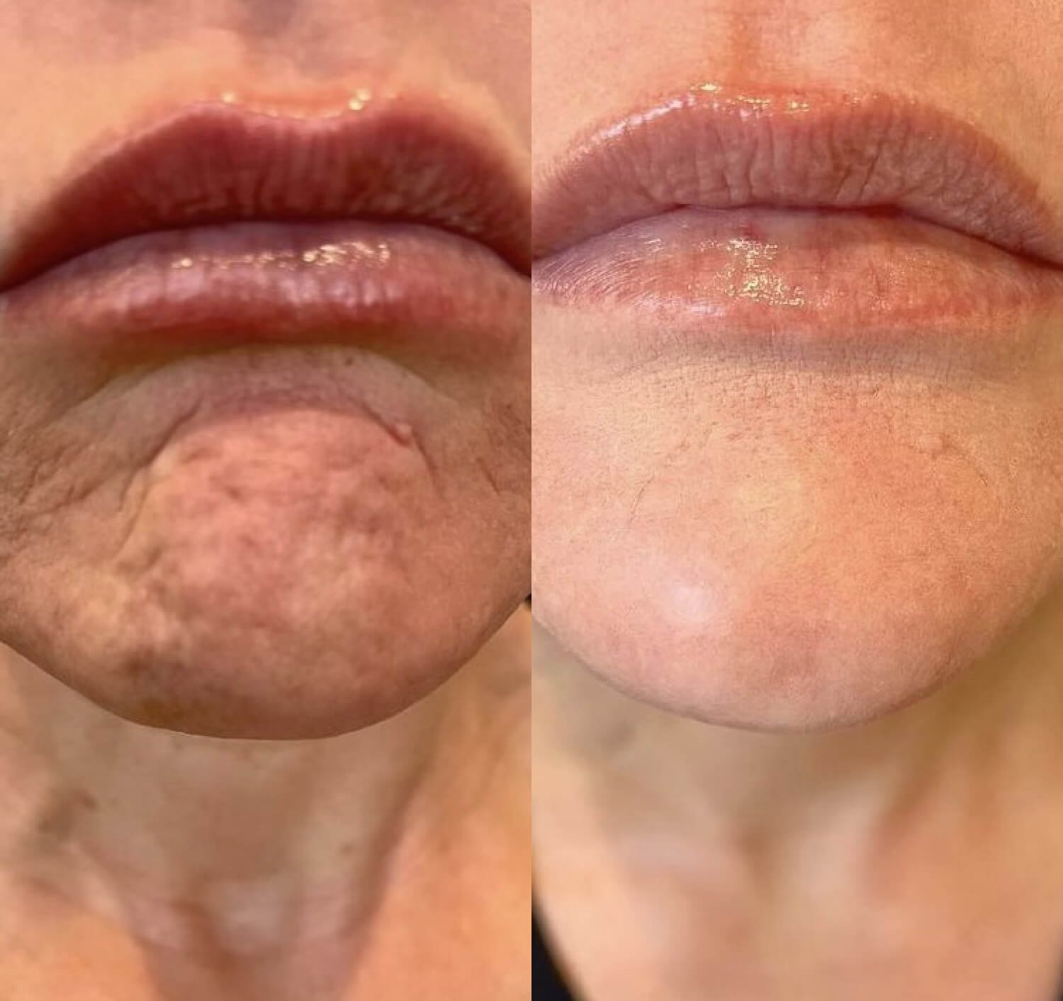 Lisa Azevedo botox natural looking lip results before and after.jpg