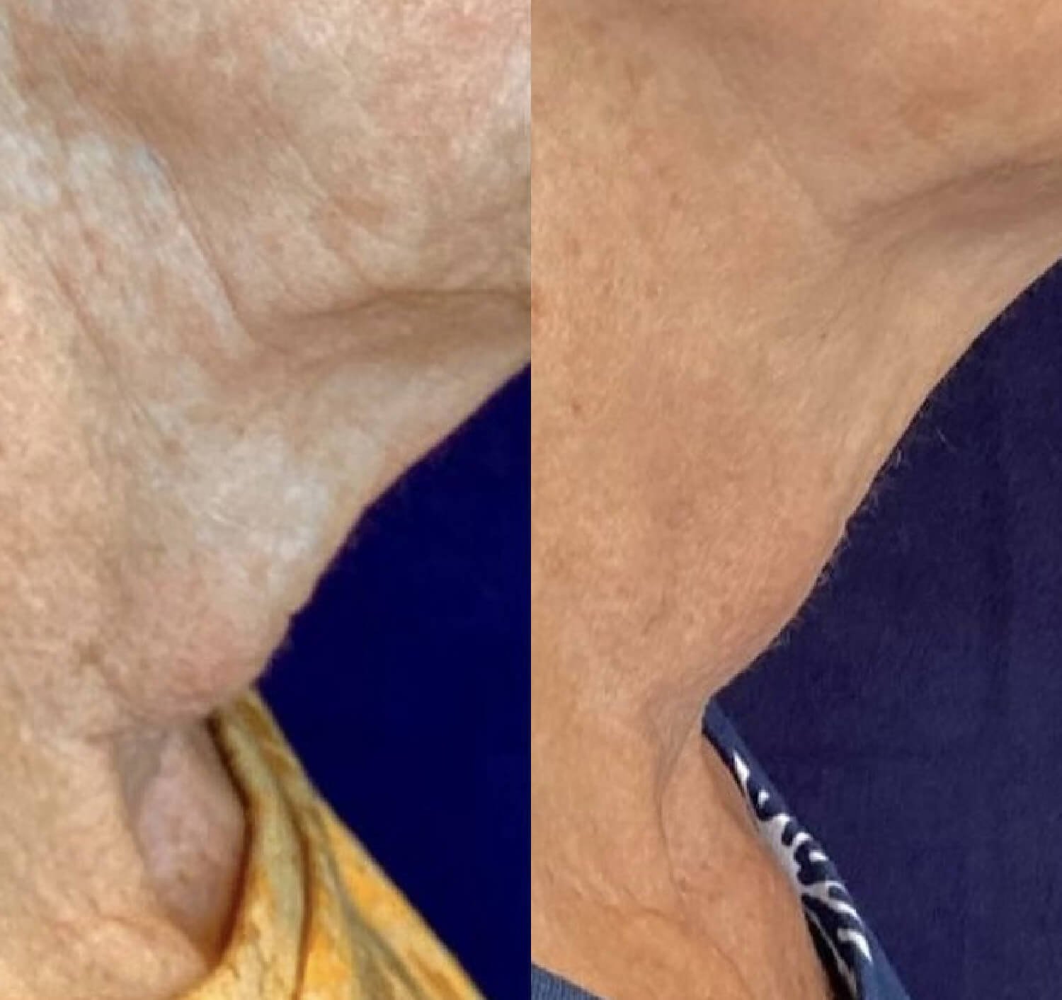 Lisa Azevedo neck rejuvenation before and after.jpg