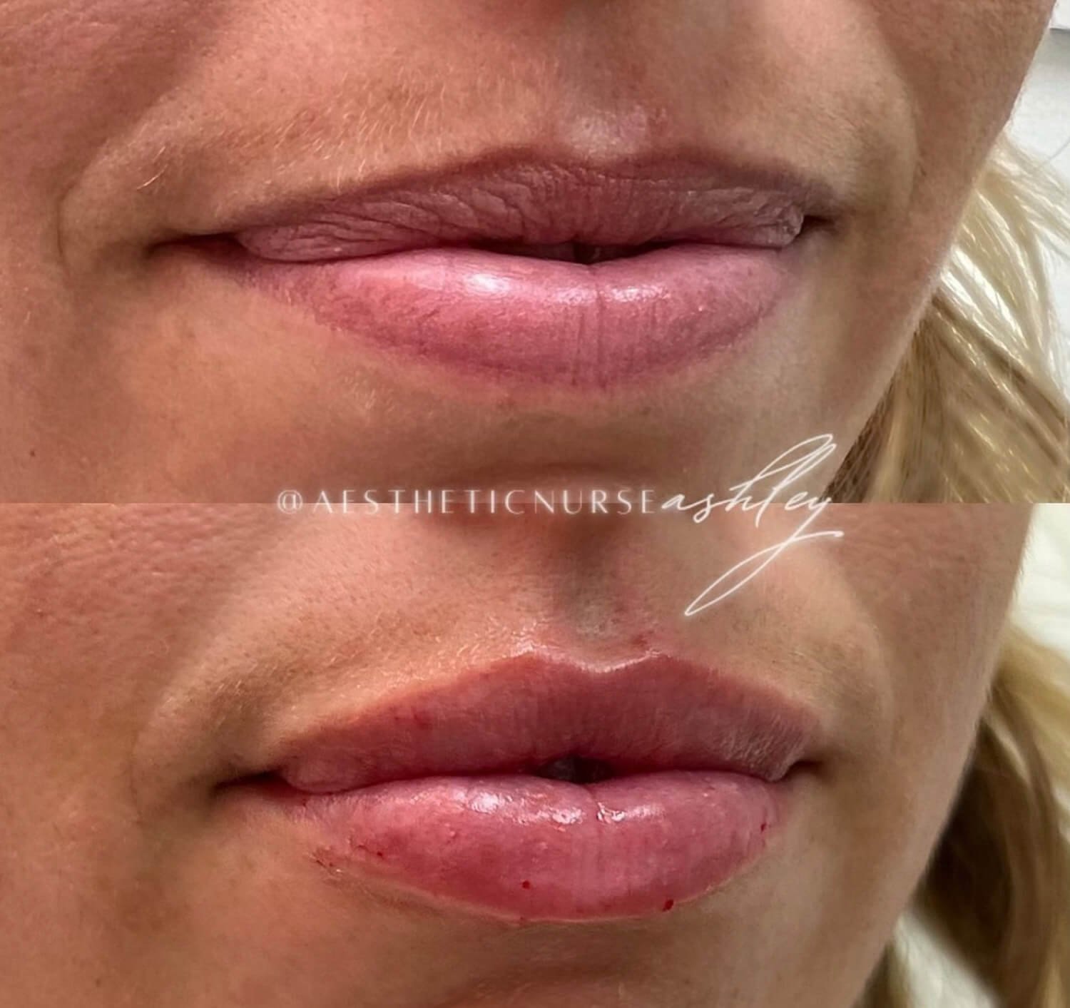 Ashley Reader natural looking lip enhancement botox filler before and after.jpg