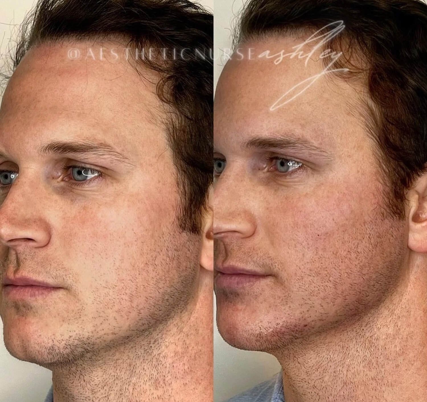Ashley Reader men botox before and after.jpg