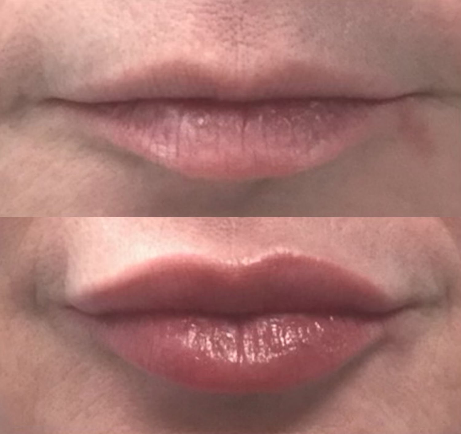 Christine Yanikian lip filler before and after.jpg