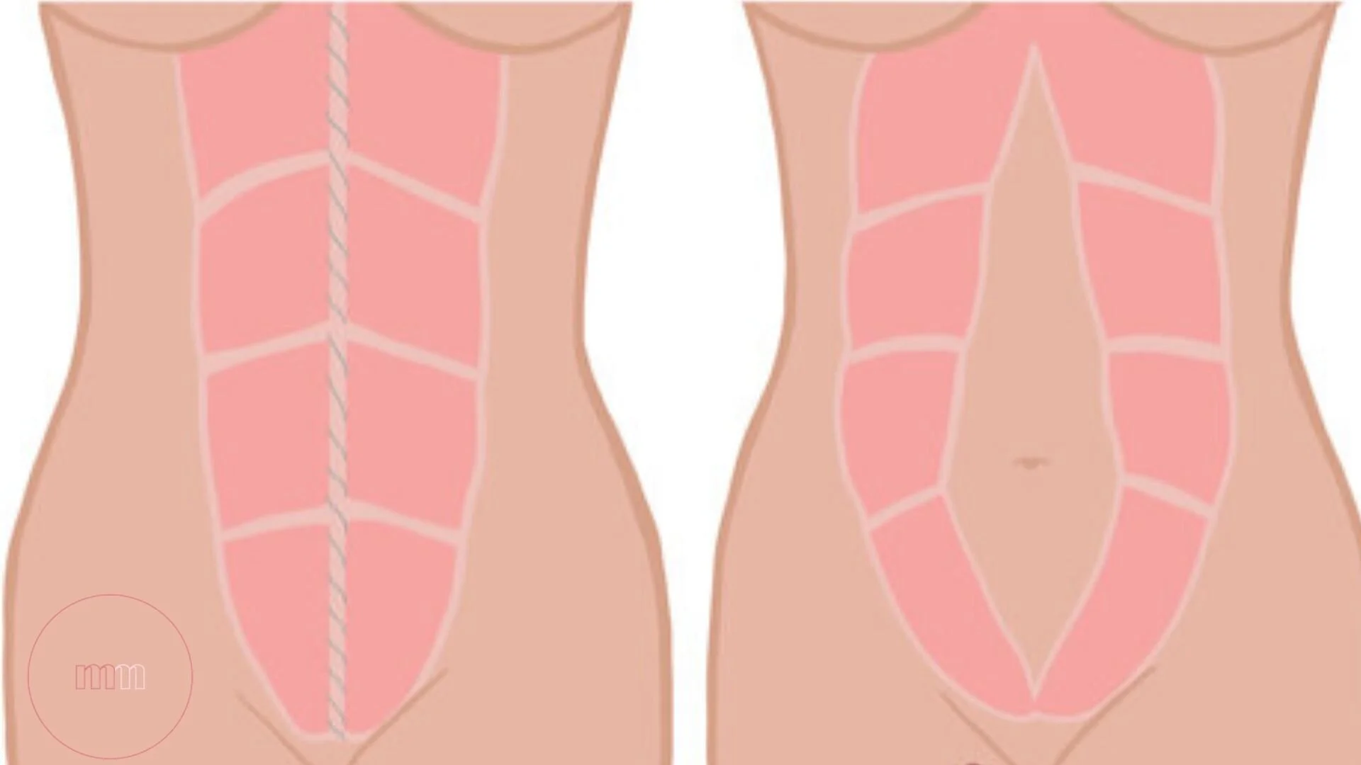 The Wrap On Abdominal Separation — Kindred Physiotherapy - Megan Mullane
