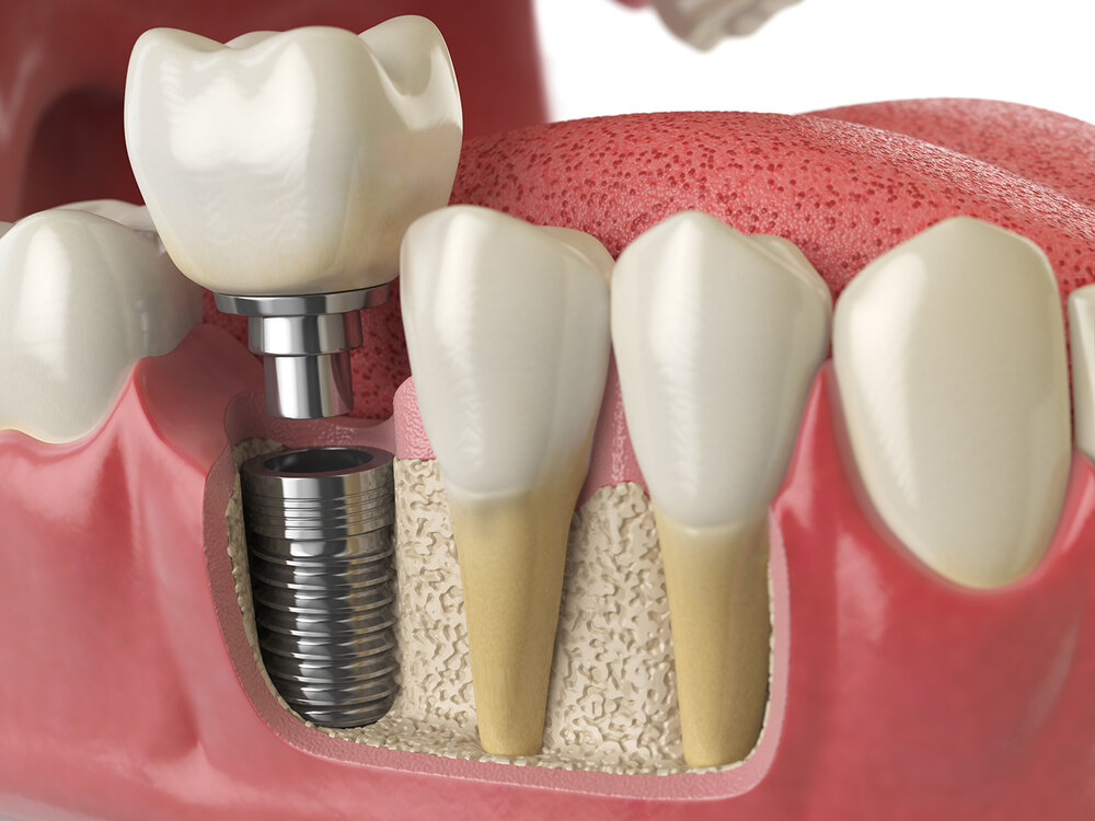 Dental Implants Canberra — Canberra Oral & Maxillofacial Centre | Dr Ragu  Krishnamoorthy | Deakin