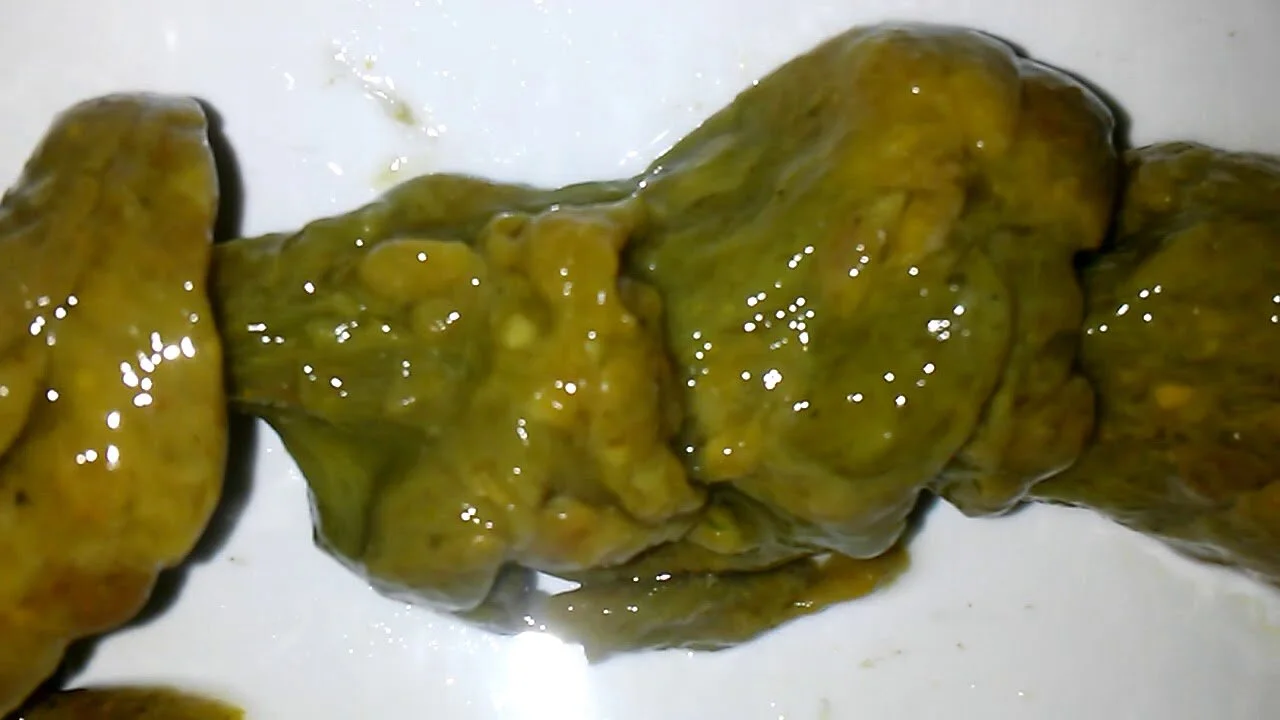 Mucoid Plaque — Sura Detox Retreats