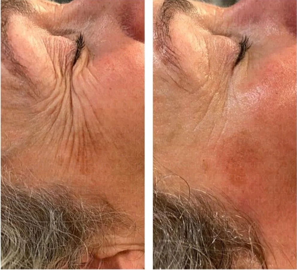 Before & After One RF Trio Treatment.