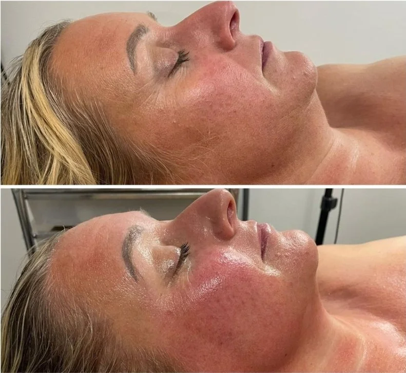 Before & After Two RF Trio Treatments.