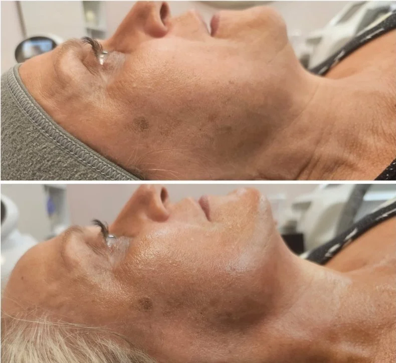 Before & After Four RF Trio Treatments.