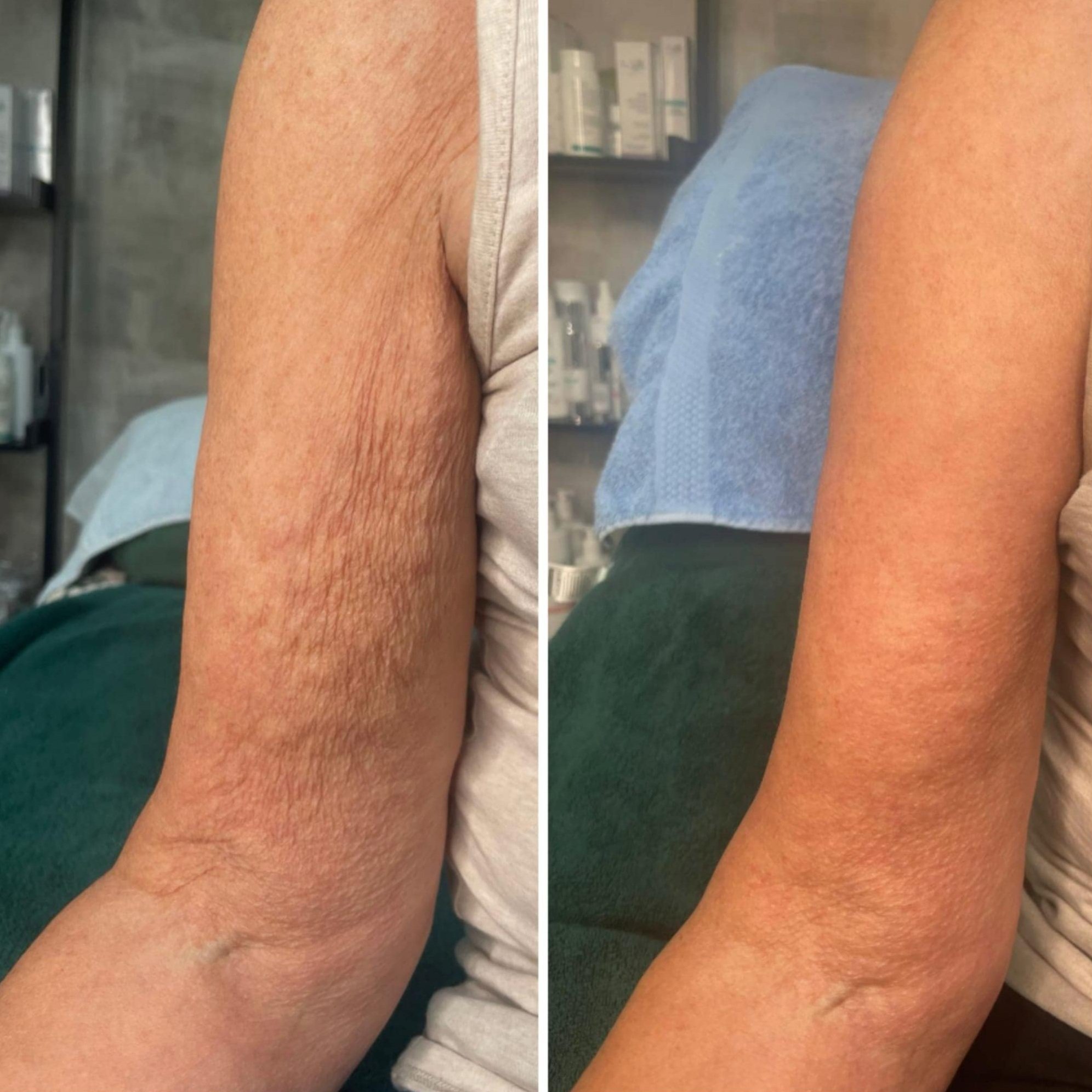 Before & After One RF Trio Treatment.