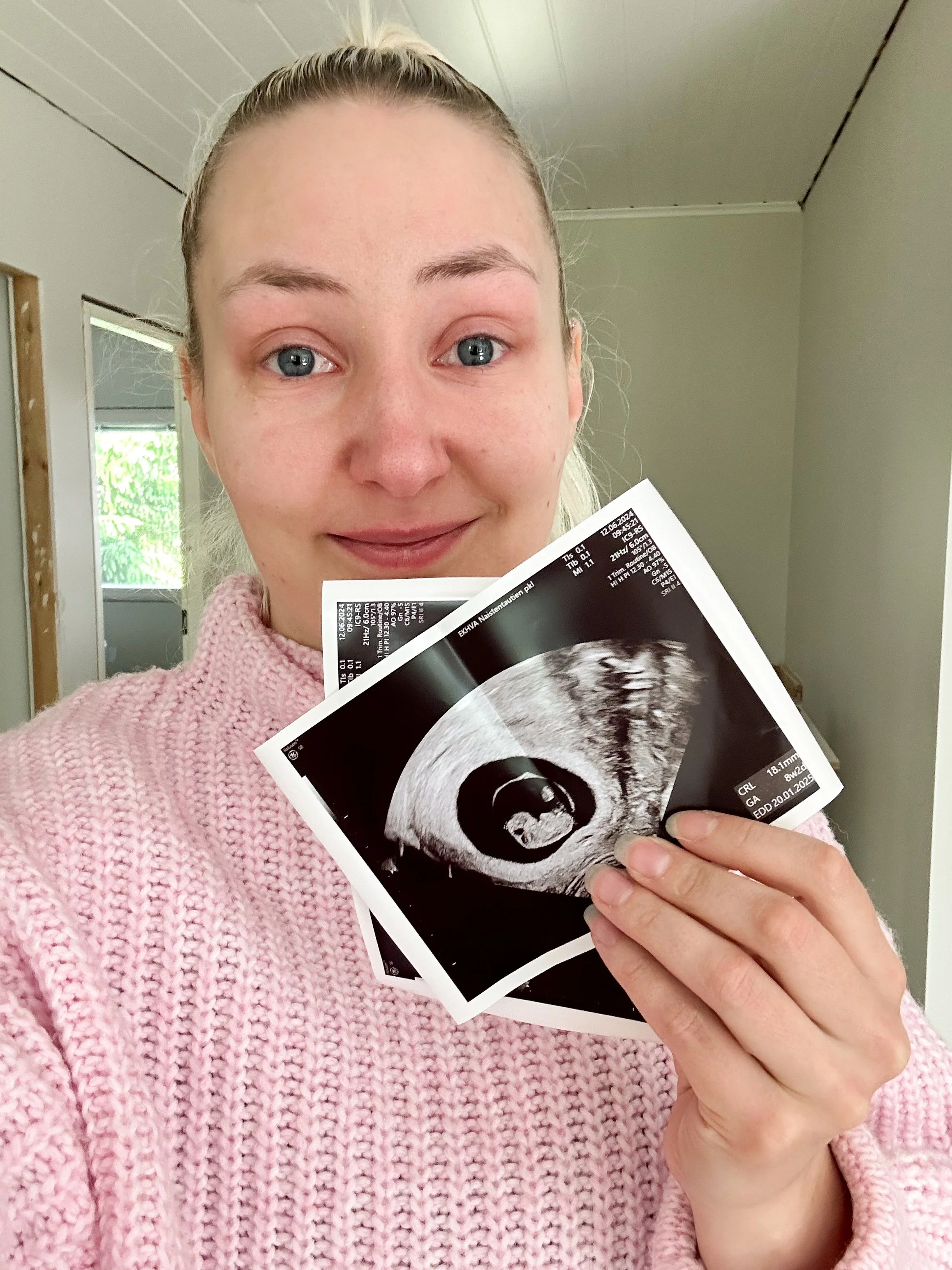  Varhaisultrasta kotiin silmät turvonneena ja niin huojentuneena 