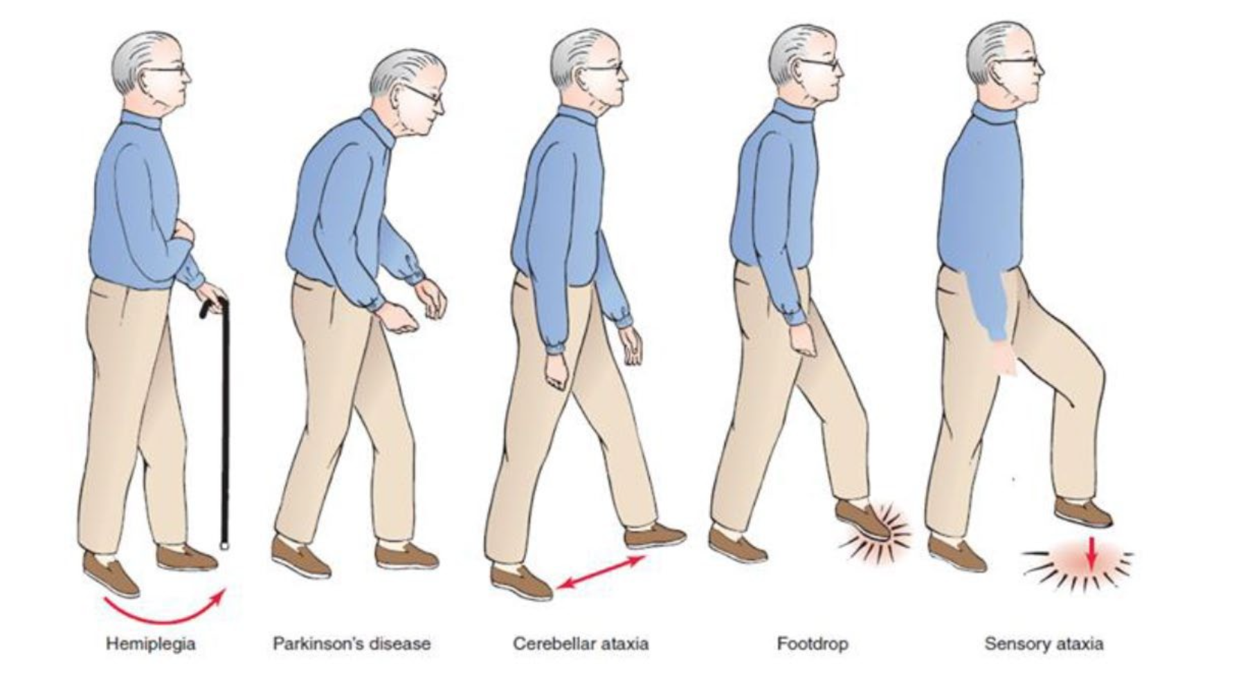 Болезнь Паркинсона походка. Походка при болезни Паркинсона. Походка больного Паркинсоном. Нарушение походки.