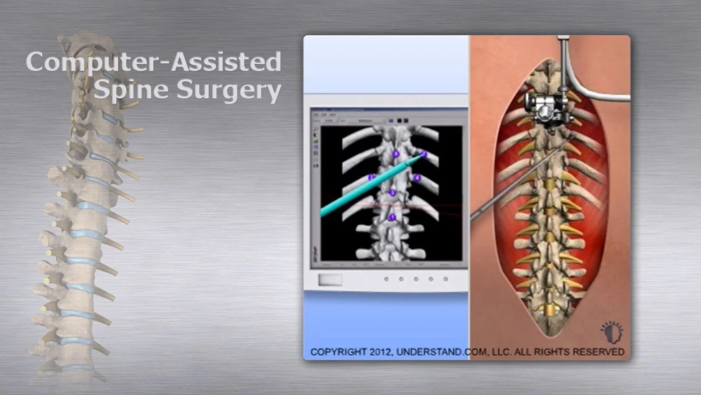 Computer-Assisted Spine Surgery