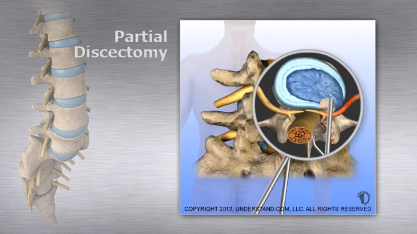 Partial Discectomy