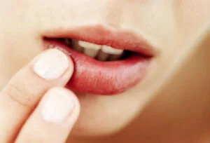 Cold sores increase Alzheimer's risk