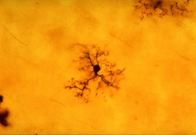 Blocking Receptor in the Brain’s Immune Cells Reverses Alzheimer’s