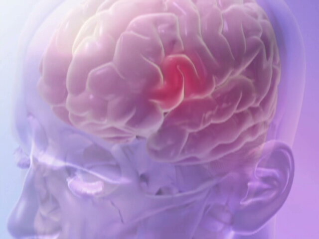 Stutterers Experience Abnormal Brain Development As They Age