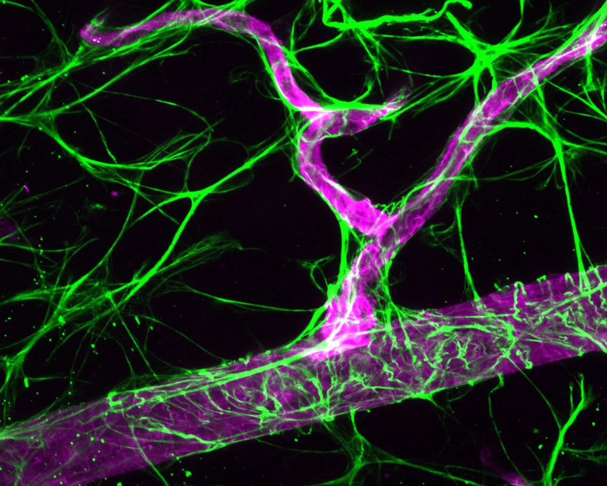 Alzheimer's - Do the “Eyes” Really Have It?