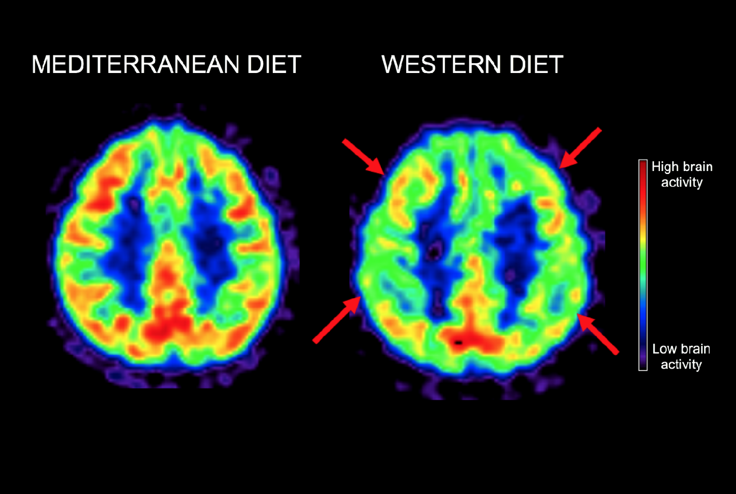 High brains. Pet scan Brain. High Brain activity.