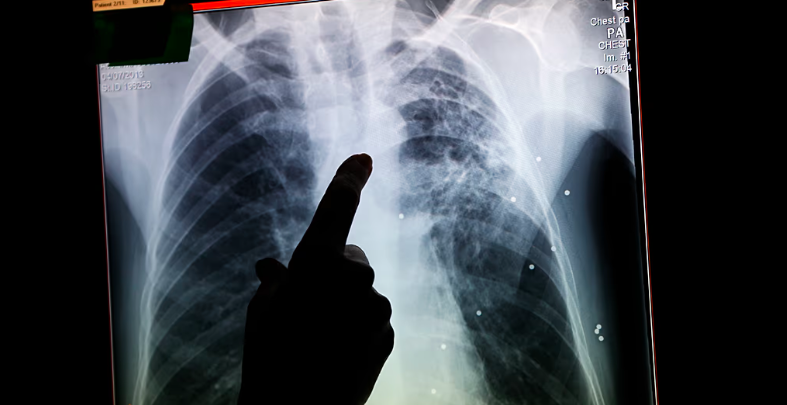 A healthcare professional's hand pointing at an X-ray of a chest on a lightbox or screen.