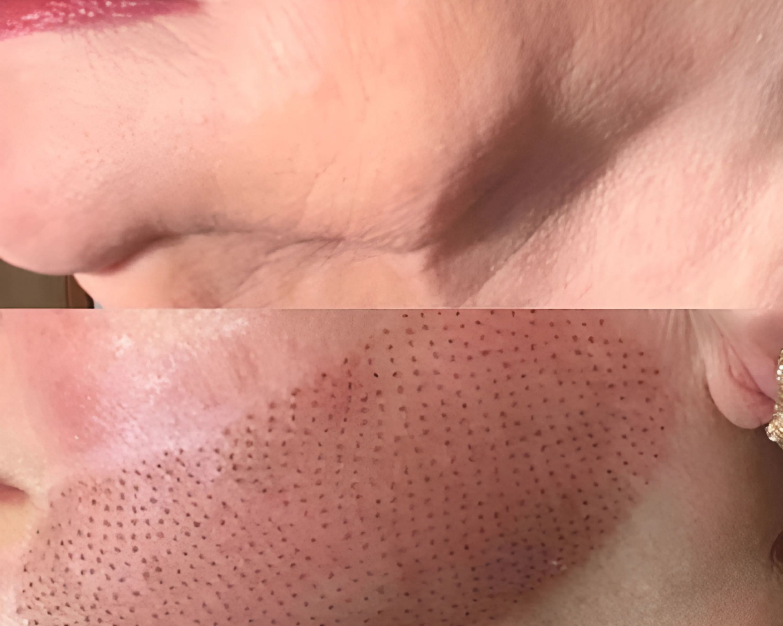 Plasma Pen Secrets: The Skin-Tightening “Soft Surgery” That Actually Works