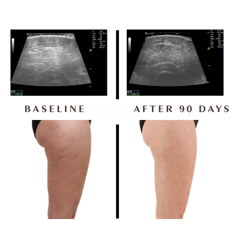 Cellulite Sculpt Series