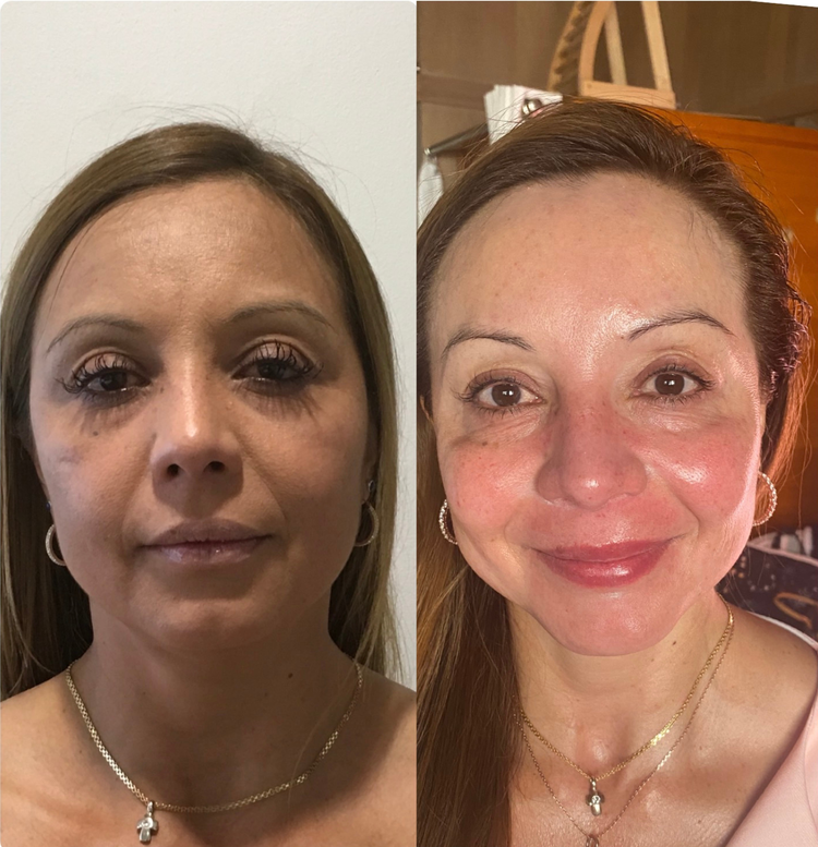 Fascia FaceLIFT Before and After 1
