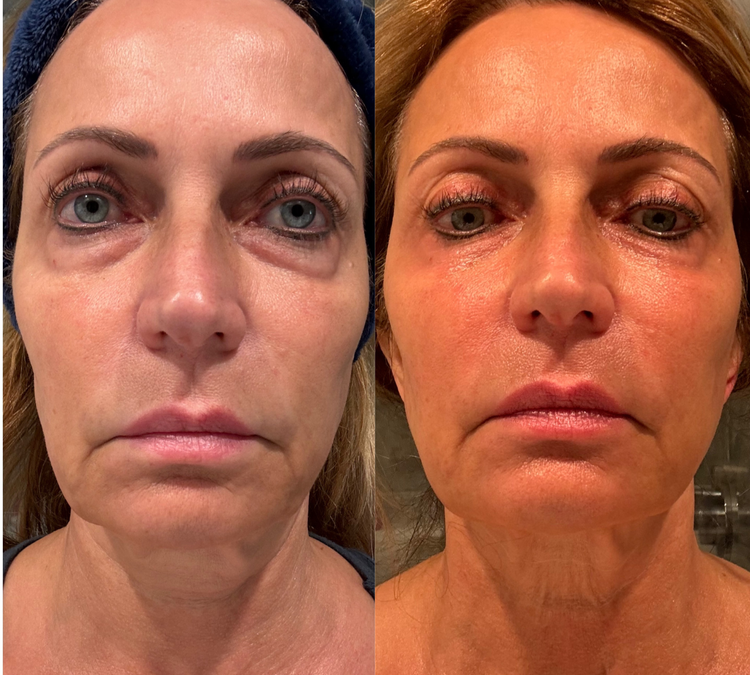 Fascia FaceLIFT Before and After 4