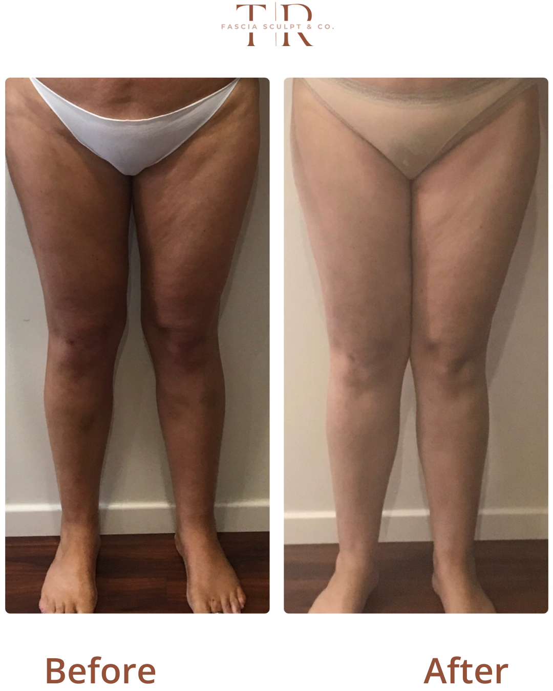 FasciaTHERAPY Body Before & After: Real Client Results