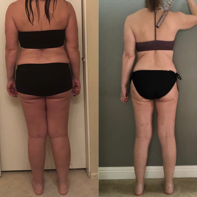 Cellulite Sculpt before and after body transformation