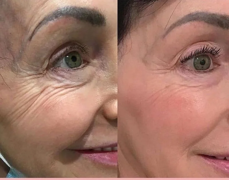 PlasmaPEN Crepey Skin LiftingBefore & After: Real Client Results