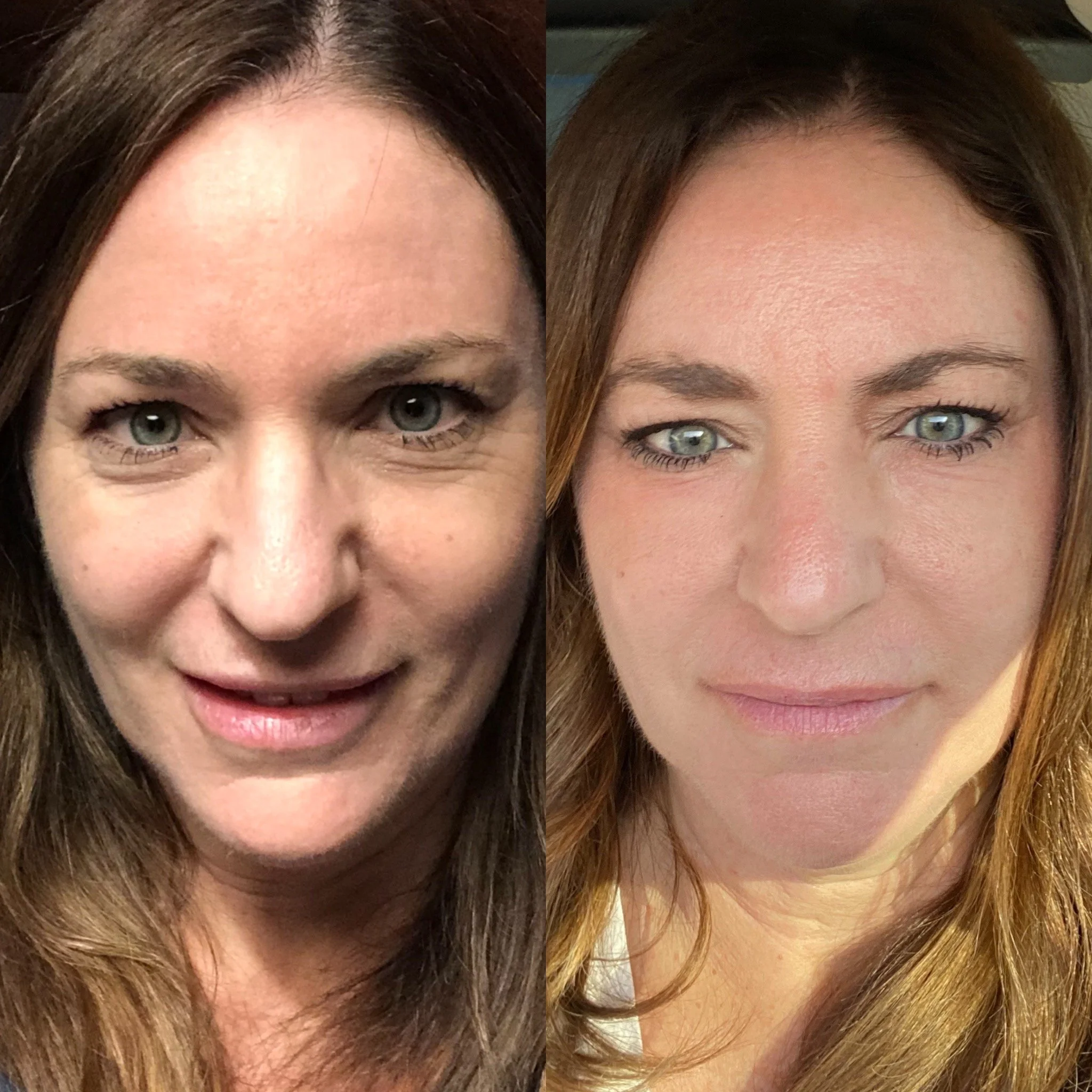 PlasmaPEN Crepey Skin LiftingBefore & After: Real Client Results