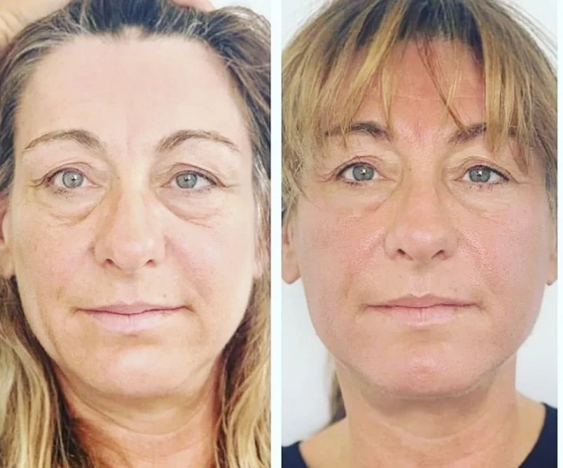 PlasmaPEN Crepey Skin LiftingBefore & After: Real Client Results