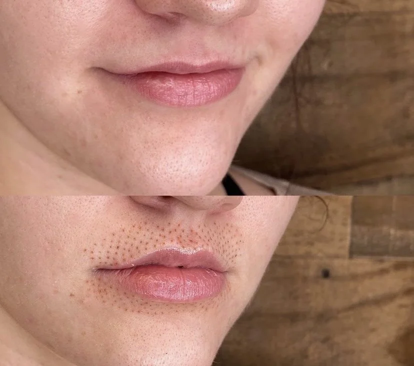 PlasmaPEN Crepey Skin LiftingBefore & After: Real Client Results